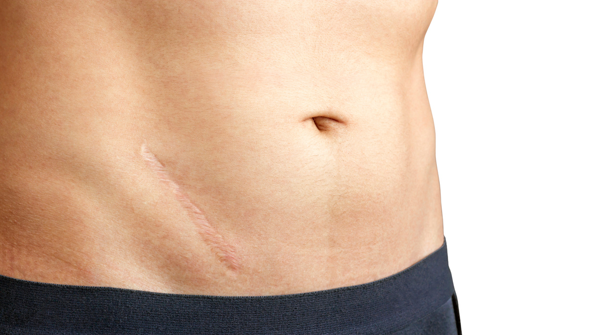 scars removal concept. Closeup of young man with large scar after surgery on abdomen, removal of appendicitis.